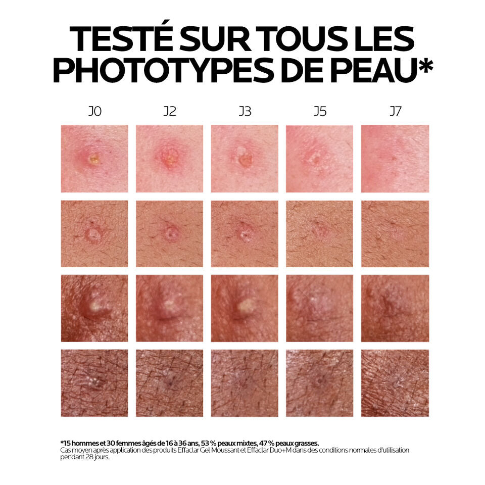 La Roche-Posay Effaclar Duo+ Triple-Correction Blemish Treatment