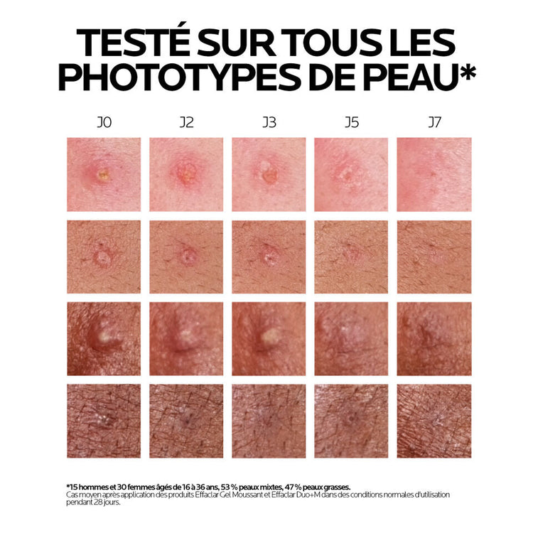La Roche-Posay Effaclar Duo+ Triple-Correction Blemish Treatment